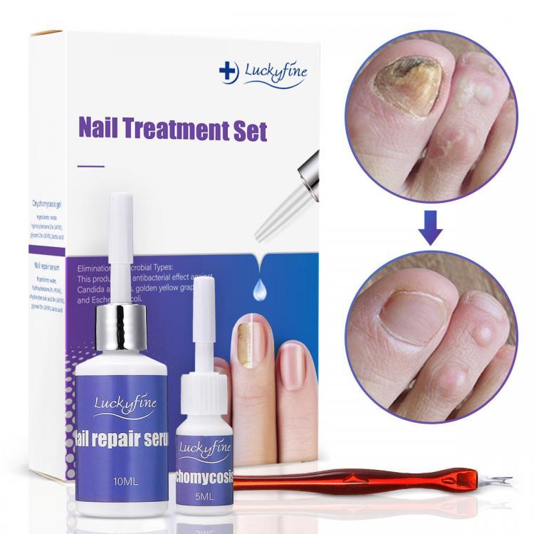 shopping טיפוח העור LuckyFine Toenail Fungus Treatment Set Onychomycosis Gel Nail Repair Serum Nail Care Tool